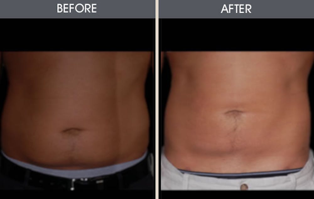 Liposuction Gallery Before & After Gallery - Patient 2207212 - Image 1