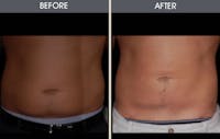 Liposuction Before & After Gallery - Patient 2207212 - Image 1