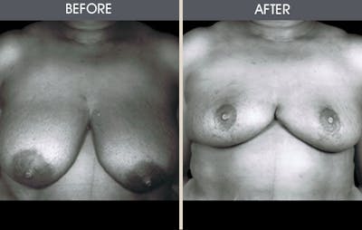 Breast Reduction Gallery Before & After Gallery - Patient 2207214 - Image 1