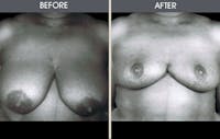 Breast Reduction Before & After Gallery - Patient 2207214 - Image 1
