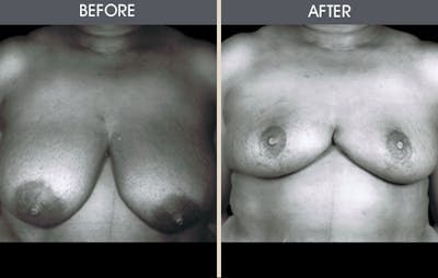 Breast Reduction Before & After Gallery - Patient 2207214 - Image 1