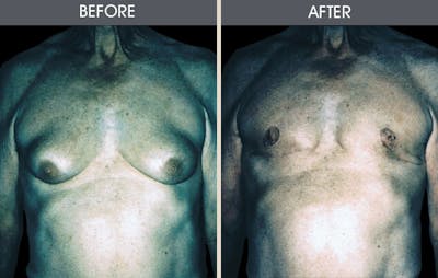 Male Breast Reduction (Gynecomastia) Gallery Before & After Gallery - Patient 2207216 - Image 1