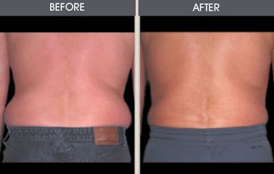 Dr. Antell's Liposuction before & after photo #6