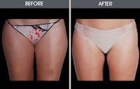 Liposuction Before & After Gallery - Patient 2207222 - Image 1