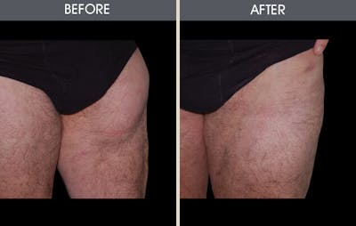 Dr. Antell's Liposuction before & after photo #7