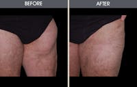 Liposuction Gallery Before & After Gallery - Patient 2207223 - Image 1