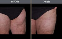 Liposuction Before & After Gallery - Patient 2207223 - Image 1
