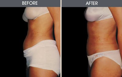 Dr. Antell's Liposuction before & after photo #8