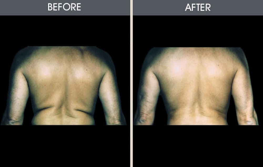 Liposuction Gallery Before & After Gallery - Patient 2207225 - Image 1