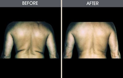 Liposuction Gallery Before & After Gallery - Patient 2207225 - Image 1