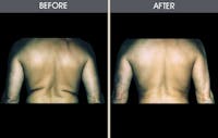 Liposuction Gallery Before & After Gallery - Patient 2207225 - Image 1