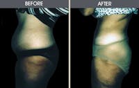 Liposuction Before & After Gallery - Patient 2207226 - Image 1
