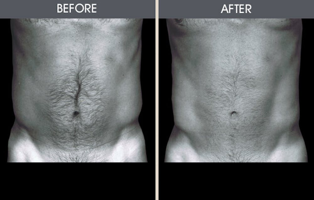 Liposuction Gallery Before & After Gallery - Patient 2207228 - Image 1