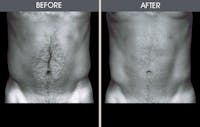 Liposuction Gallery Before & After Gallery - Patient 2207228 - Image 1