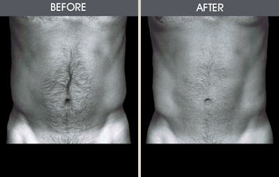 Liposuction Before & After Gallery - Patient 2207228 - Image 1