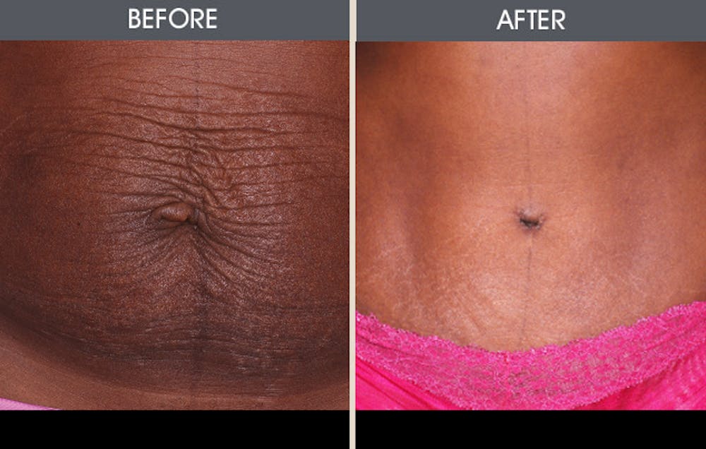 Tummy Tuck Gallery Before & After Gallery - Patient 2207229 - Image 1
