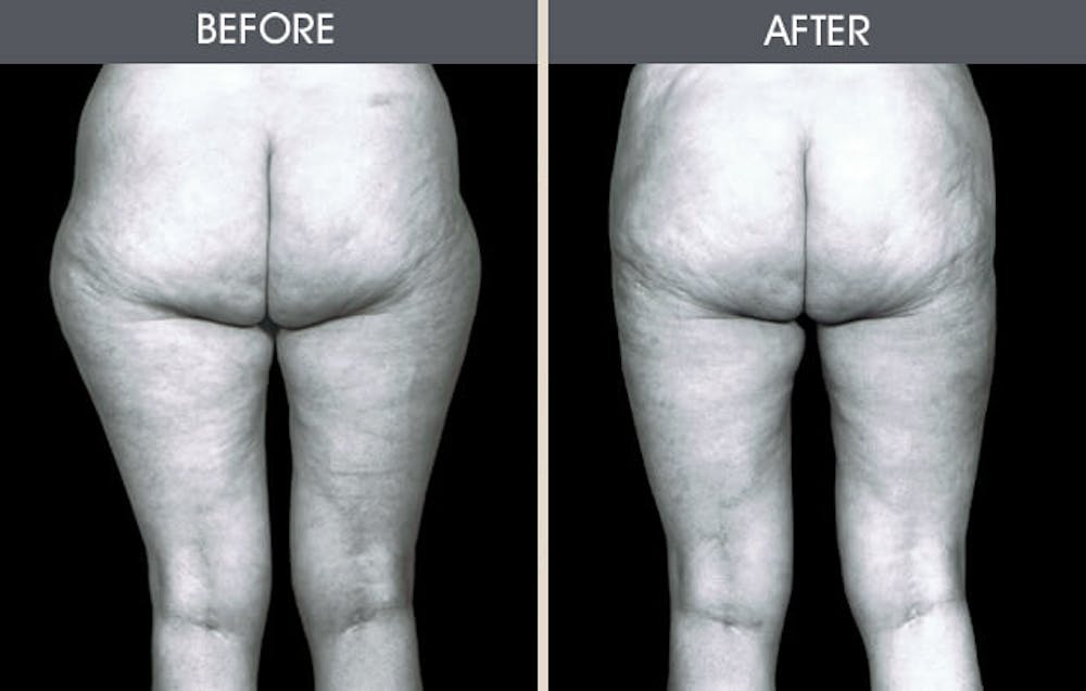 Liposuction Gallery Before & After Gallery - Patient 2207230 - Image 1
