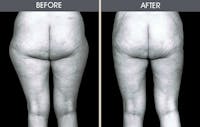 Liposuction Gallery Before & After Gallery - Patient 2207230 - Image 1