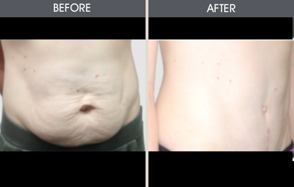 Tummy Tuck Gallery - Patient 2207231 - Image 1