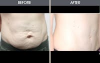 Tummy Tuck Before & After Gallery - Patient 2207231 - Image 1