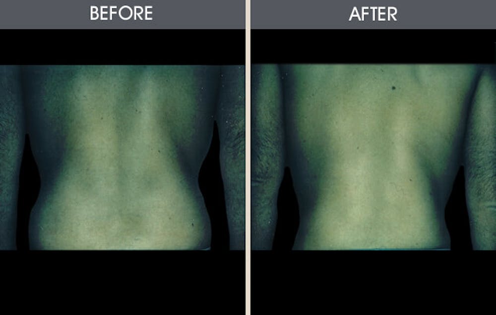 Liposuction Gallery Before & After Gallery - Patient 2207232 - Image 1