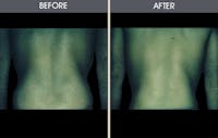 Liposuction Gallery Before & After Gallery - Patient 2207232 - Image 1