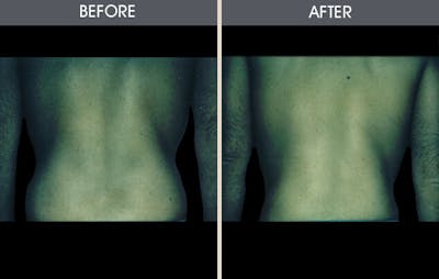 Liposuction Before & After Gallery - Patient 2207232 - Image 1