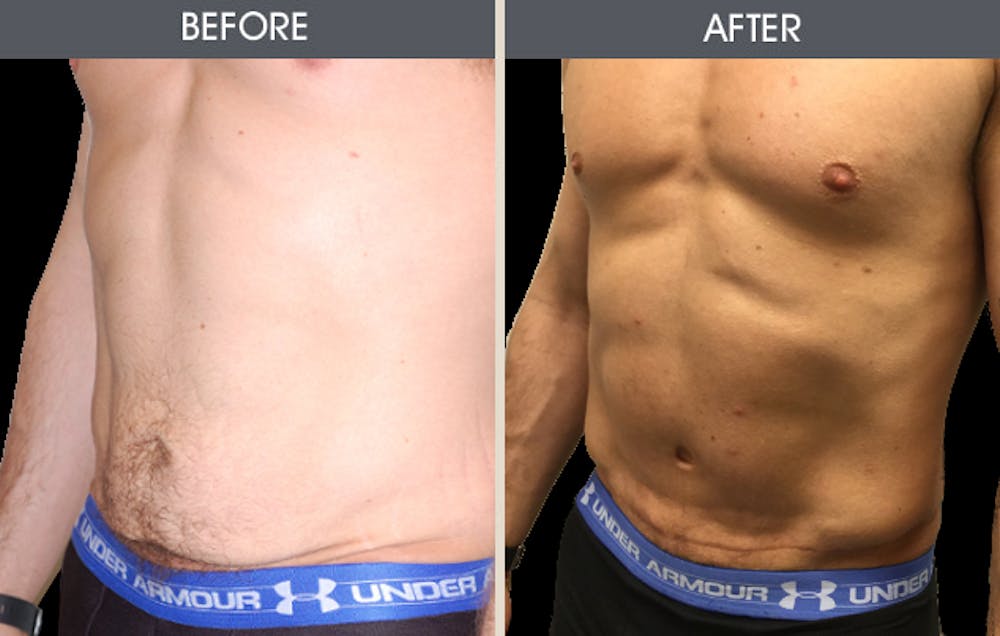 Tummy Tuck Before & After Gallery - Patient 2207233 - Image 1