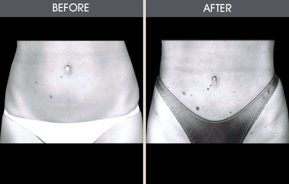 Liposuction Gallery Before & After Gallery - Patient 2207234 - Image 1