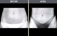 Liposuction Gallery Before & After Gallery - Patient 2207234 - Image 1
