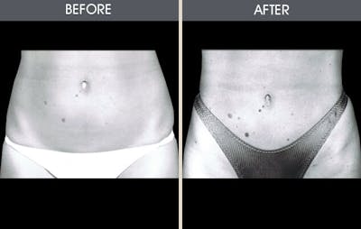 Liposuction Before & After Gallery - Patient 2207234 - Image 1