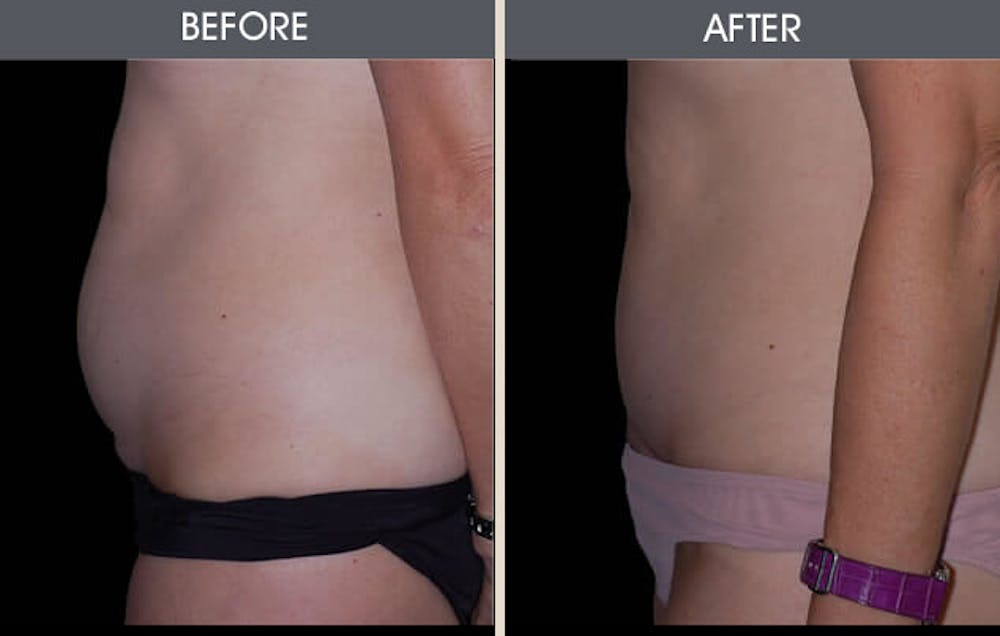 Tummy Tuck Gallery Before & After Gallery - Patient 2207236 - Image 1