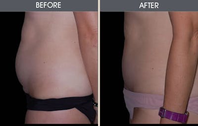 Tummy Tuck Before & After Gallery - Patient 2207236 - Image 1