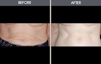 Tummy Tuck Before & After Gallery - Patient 2207238 - Image 1