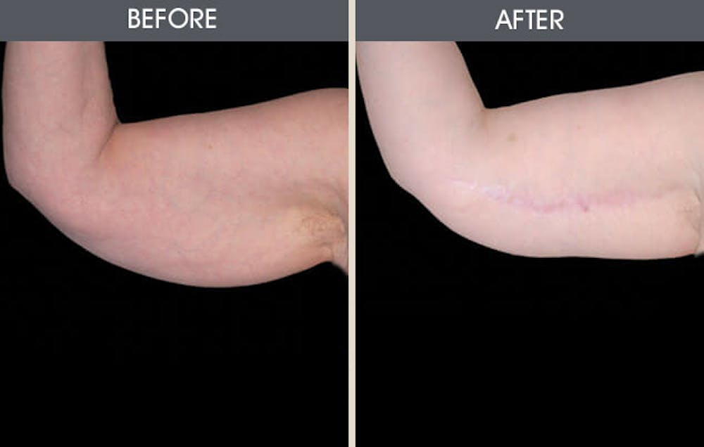 Arm Lift (Brachioplasty) Gallery Before & After Gallery - Patient 2207240 - Image 1