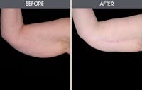 Arm Lift (Brachioplasty) Gallery Before & After Gallery - Patient 2207240 - Image 1