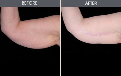 Arm Lift (Brachioplasty) Before & After Gallery - Patient 2207240 - Image 1
