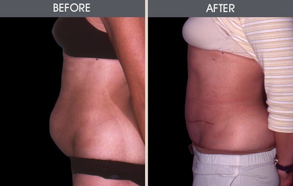 Tummy Tuck Gallery Before & After Gallery - Patient 2207241 - Image 1