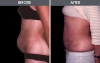 Tummy Tuck Before & After Gallery - Patient 2207241 - Image 1