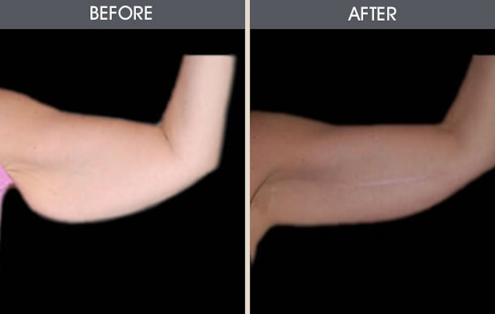 Arm Lift (Brachioplasty) Gallery Before & After Gallery - Patient 2207243 - Image 1