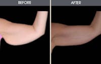 Arm Lift (Brachioplasty) Gallery Before & After Gallery - Patient 2207243 - Image 1