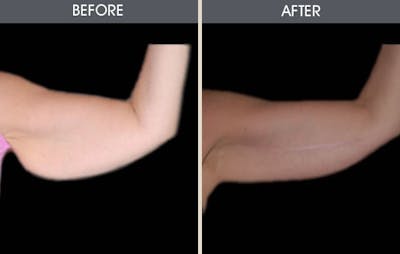 Arm Lift (Brachioplasty) Gallery Before & After Gallery - Patient 2207243 - Image 1