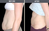 Tummy Tuck Before & After Gallery - Patient 2207244 - Image 1