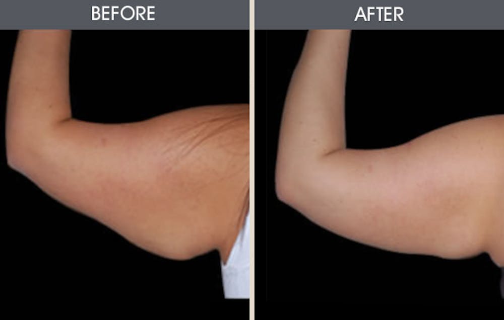 Arm Lift (Brachioplasty) Gallery Before & After Gallery - Patient 2207245 - Image 1