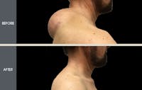 Lipoma Removal Before & After Gallery - Patient 2207248 - Image 1