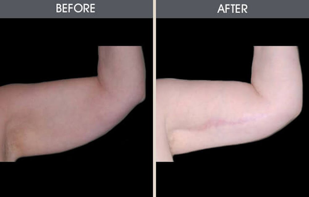 Arm Lift (Brachioplasty) Gallery Before & After Gallery - Patient 2207247 - Image 1