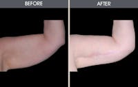 Arm Lift (Brachioplasty) Gallery Before & After Gallery - Patient 2207247 - Image 1