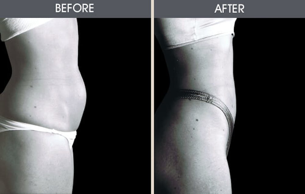 Tummy Tuck Gallery Before & After Gallery - Patient 2207249 - Image 1