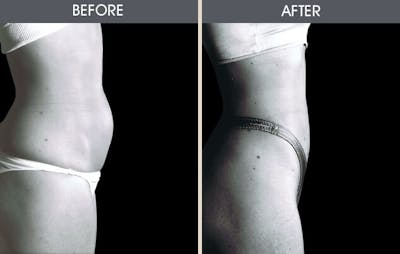 Tummy Tuck Gallery Before & After Gallery - Patient 2207249 - Image 1