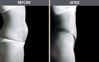 Tummy Tuck Gallery Before & After Gallery - Patient 2207249 - Image 1